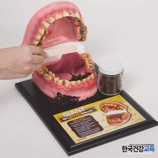 흡연자의 구강모형 담배교육모형 3D모형