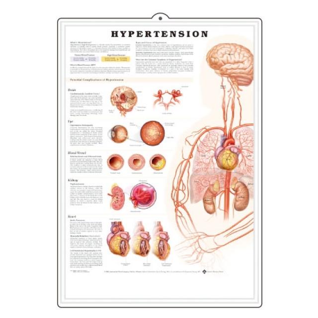 MEDIPRO 고혈압의 합병증 3D 인체해부도 [9767B], 1개